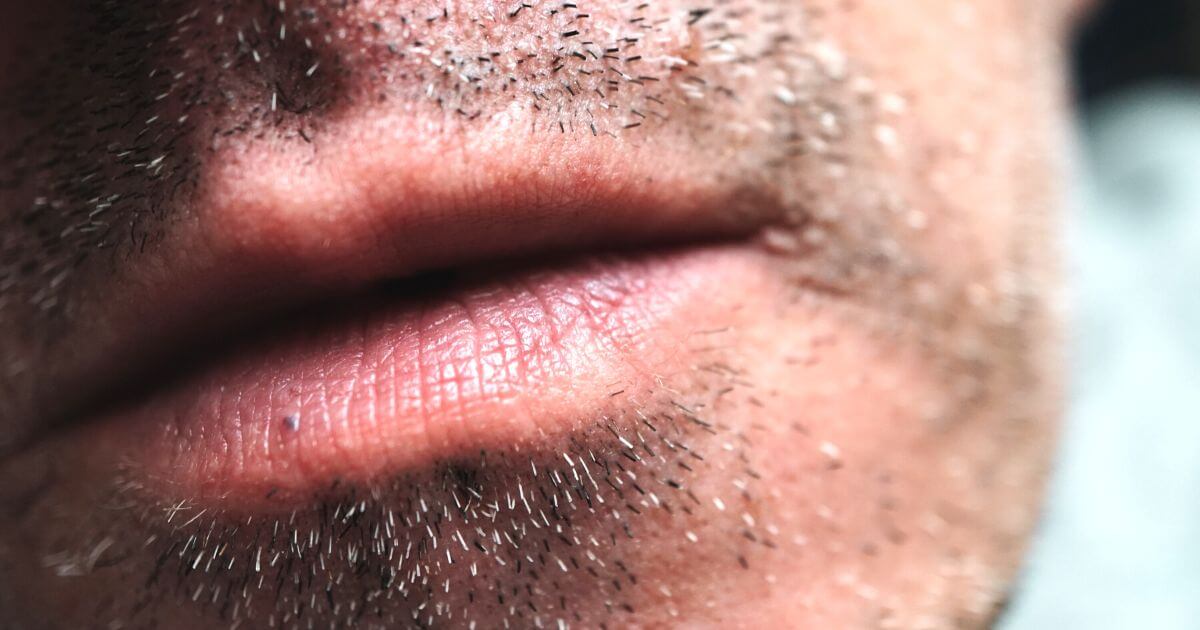 Th Vochtig lint Droge huid rond mond? Lees hier wat jij er tegen kunt doen!