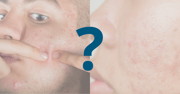 Verschil tussen acne en puisten