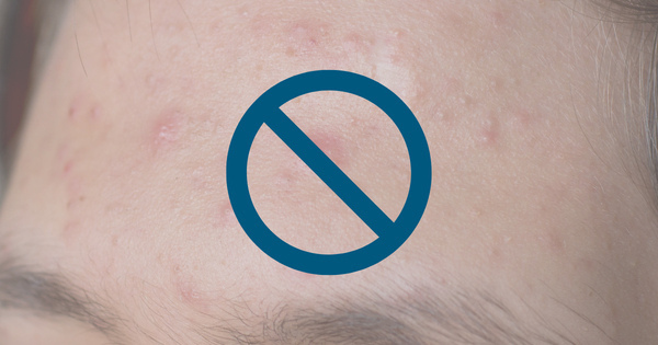 Wat maakt acne erger?