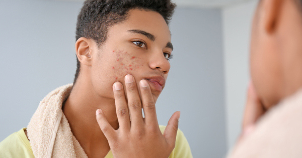 Acne besmettelijk